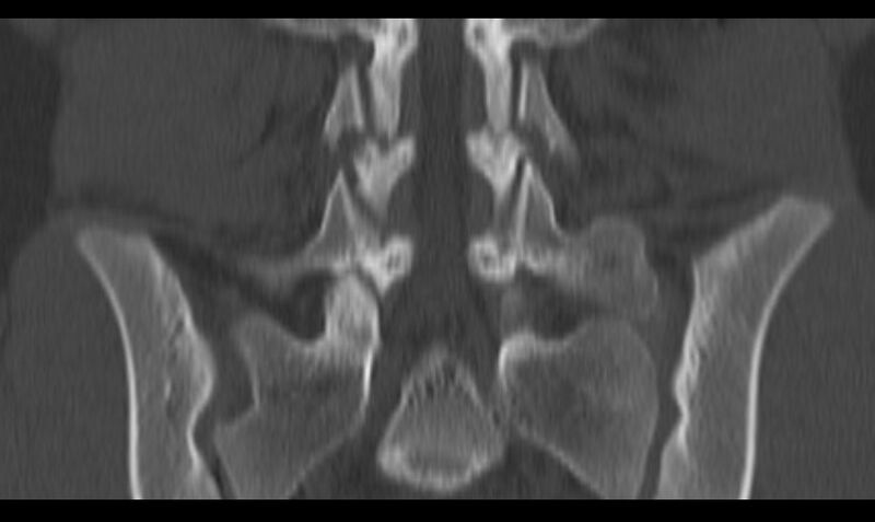 File:Bilateral pars defect (Radiopaedia 26691-26846 Coronal bone window 29).jpg