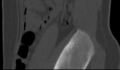 Bilateral pars defect (Radiopaedia 26691-26846 Sagittal bone window 61).jpg