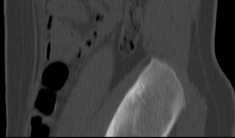 File:Bilateral pars defect (Radiopaedia 26691-26846 Sagittal bone window 61).jpg
