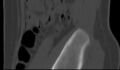 Bilateral pars defect (Radiopaedia 26691-26846 Sagittal bone window 63).jpg