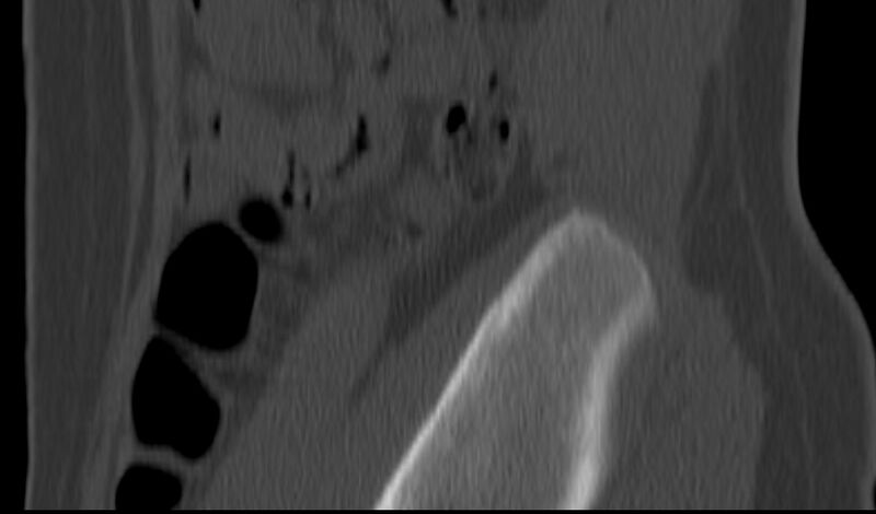 File:Bilateral pars defect (Radiopaedia 26691-26846 Sagittal bone window 63).jpg