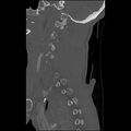 Bilateral perched facets with cord injury (Radiopaedia 45587-49713 Sagittal bone window 11).jpg
