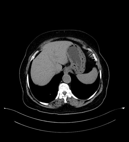 File:Bilateral sporadic synchronous clear cell renal cell carcinoma (Radiopaedia 85035-100575 Axial non-contrast 12).jpg