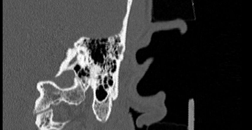 Bilateral temporal bone fractures (Radiopaedia 29482-29970 B 67).jpg