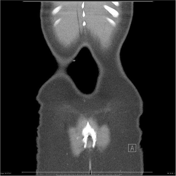File:Bilateral ureteritis and cystitis (Radiopaedia 25340-25594 B 38).jpg