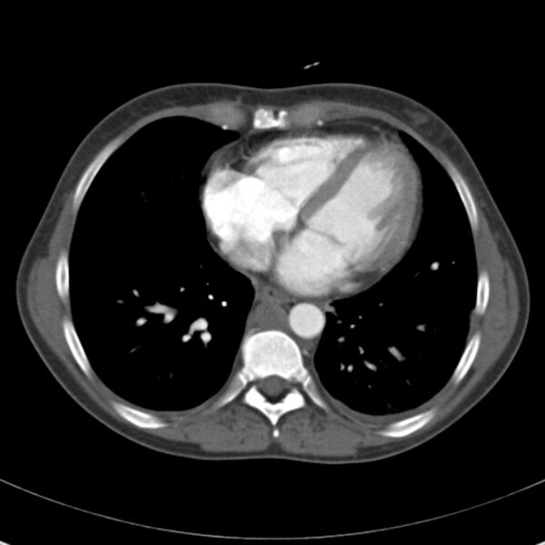 File:Biliary necrosis - liver transplant (Radiopaedia 21876-21846 A 2).jpg
