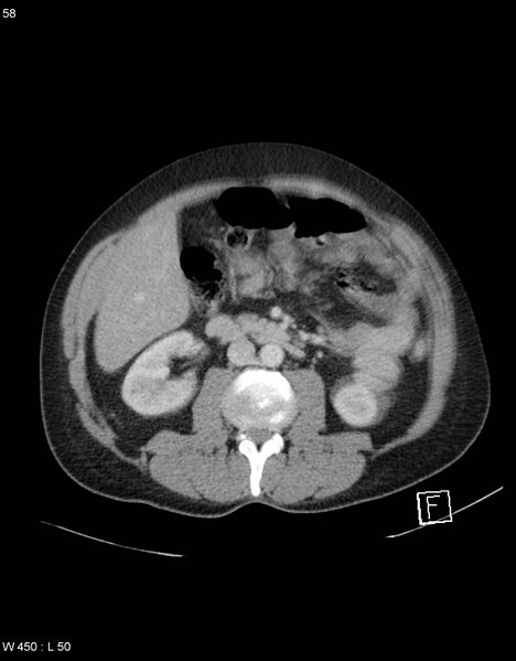 File:Boerhaave syndrome with tension pneumothorax (Radiopaedia 56794-63603 A 29).jpg