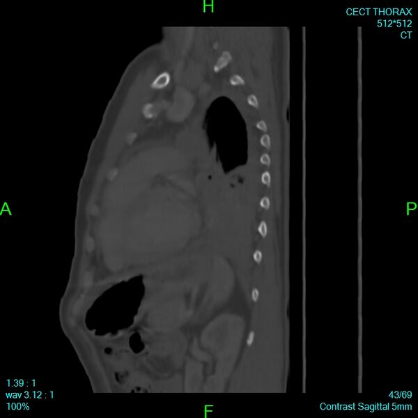File:Bone metastases from lung carcinoma (Radiopaedia 54703-60937 Sagittal bone window 43).jpg
