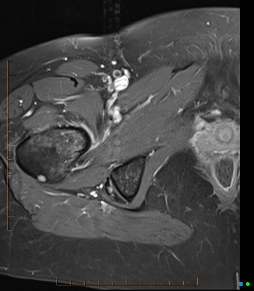 File:Bone metastasis - breast cancer (Radiopaedia 16667-16374 Axial T1 C+ fat sat 6).jpg