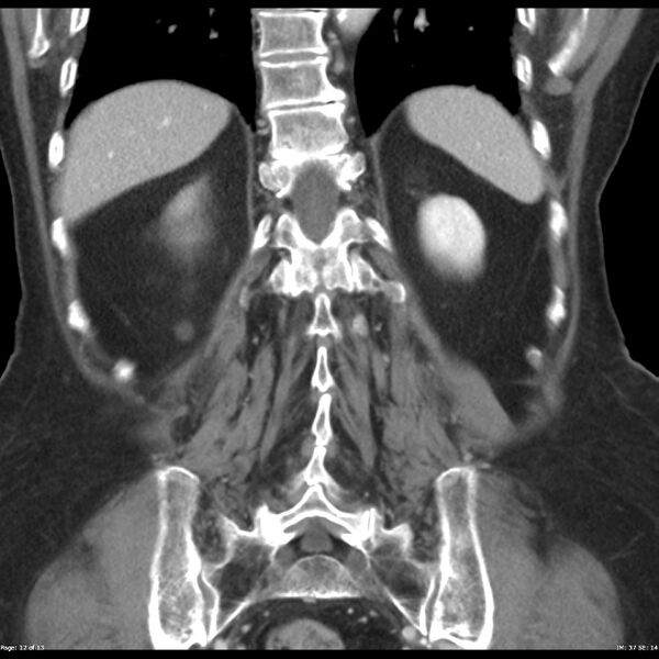 File:Bosniak renal cyst - type IIF (Radiopaedia 23385-23450 B 12).jpg