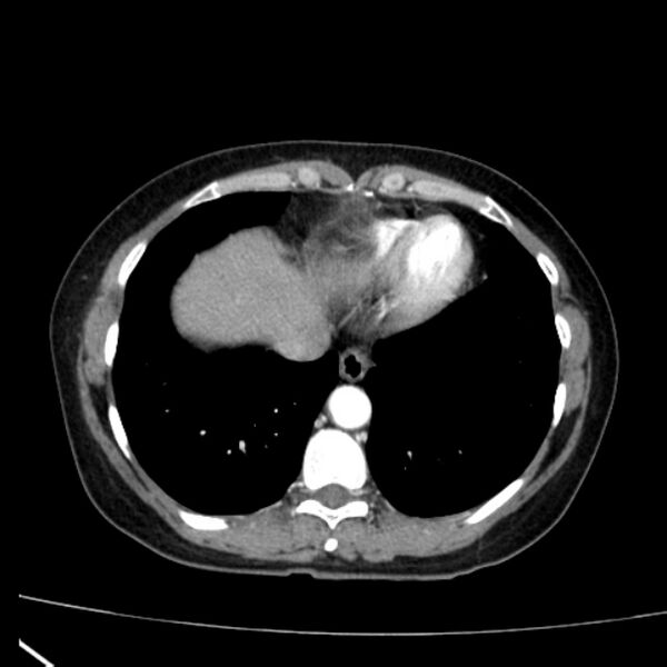 File:Bosniak renal cyst - type I (Radiopaedia 27479-27675 renal cortical phase 4).jpg