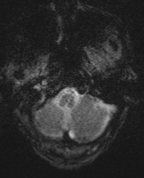 File:Brain abscess with dual rim sign (Radiopaedia 87566-103938 Axial SWI 3).jpg
