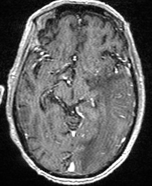 File:Brain abscess with dual rim sign (Radiopaedia 87566-103938 Axial T1 C+ 75).jpg
