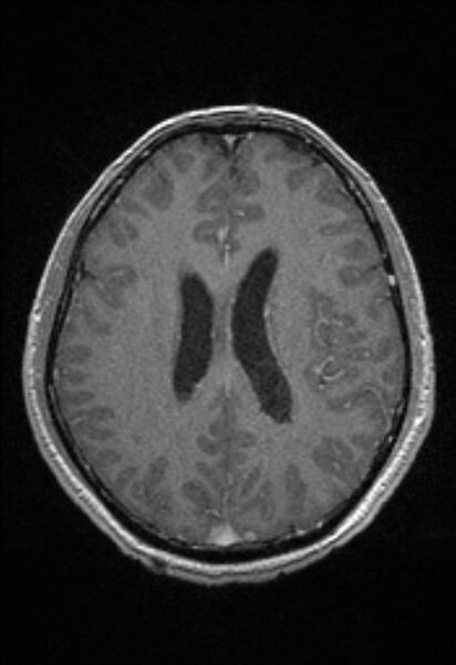 File:Brain abscess with ventriculitis (Radiopaedia 85703-101495 Axial T1 C+ 114).jpg