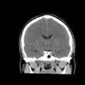 Brain death (Radiopaedia 78597-91360 Coronal non-contrast 37).jpg