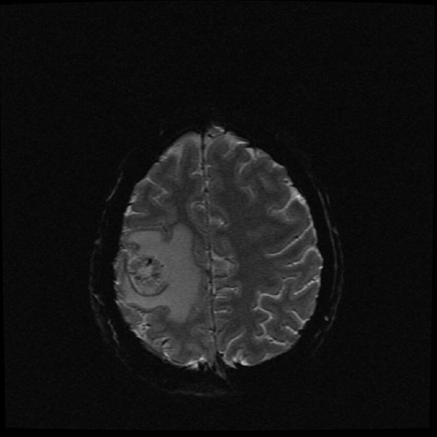 Brain metastases (renal cell carcinoma) (Radiopaedia 42571-45704 Axial SWI 10).jpg