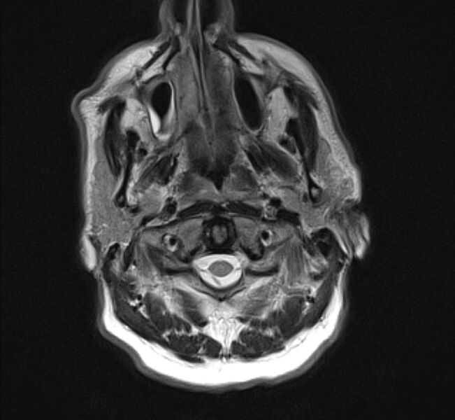 File:Brain metastases - lung cancer primary (Radiopaedia 75060-86115 Axial T2 2).jpg