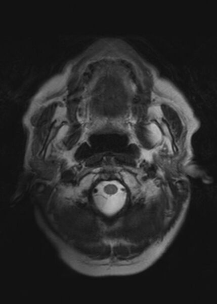 File:Brain metastases from squamocellular lung cancer (Radiopaedia 56515-63222 Axial T2 2).jpg
