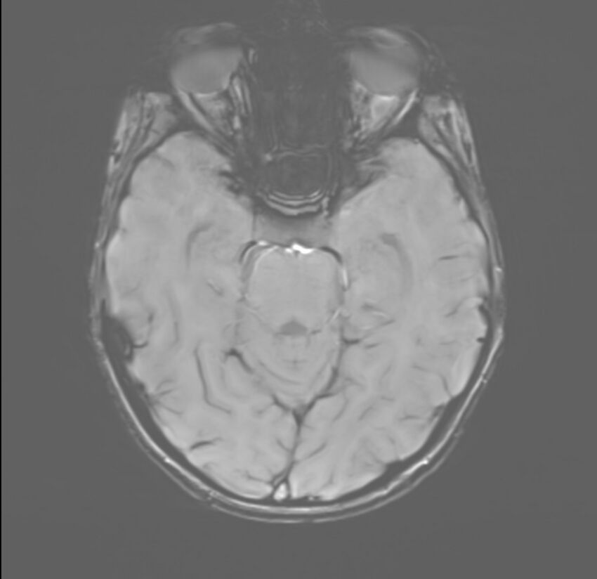 Brainstem glioma (Radiopaedia 70548-80674 Axial SWI 21).jpg