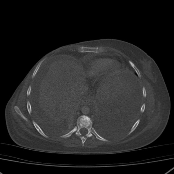 File:Breast cancer metastases - hepatic and skeletal (Radiopaedia 34201-35461 Axial bone window 28).jpg