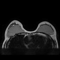 Breast implants - MRI (Radiopaedia 26864-27035 Axial T2 20).jpg