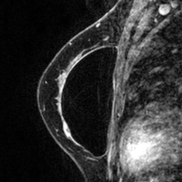 File:Breast implants - MRI (Radiopaedia 26864-27035 Sagittal T2 35).jpg