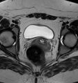 Broad ligament leiomyoma (Radiopaedia 81634-95516 Axial T2 18).jpg