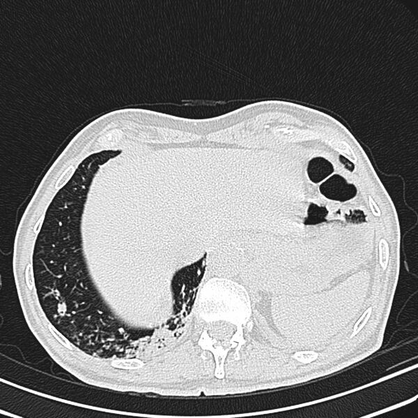 File:Bronchiectasis (Radiopaedia 22061-22059 lung window 26).jpg