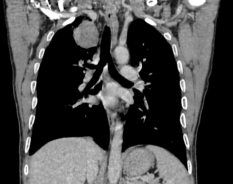 File:Bronchogenic carcinoma with superior vena cava syndrome (Radiopaedia 36497-38054 Coronal C+ delayed 56).jpg