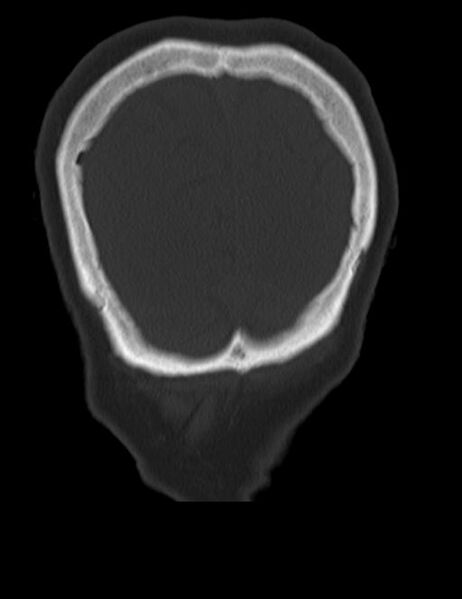File:Burnt-out meningioma (Radiopaedia 51557-57337 Coronal bone window 49).jpg