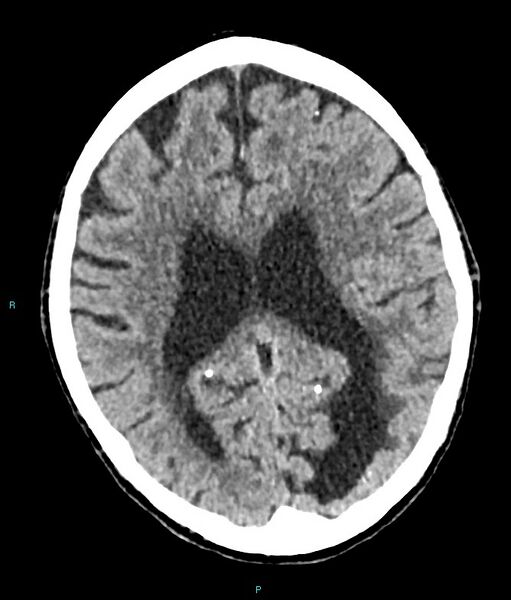 File:Calcified cerebral emboli from left ventricular thrombus (Radiopaedia 84420-99758 Axial non-contrast 39).jpg