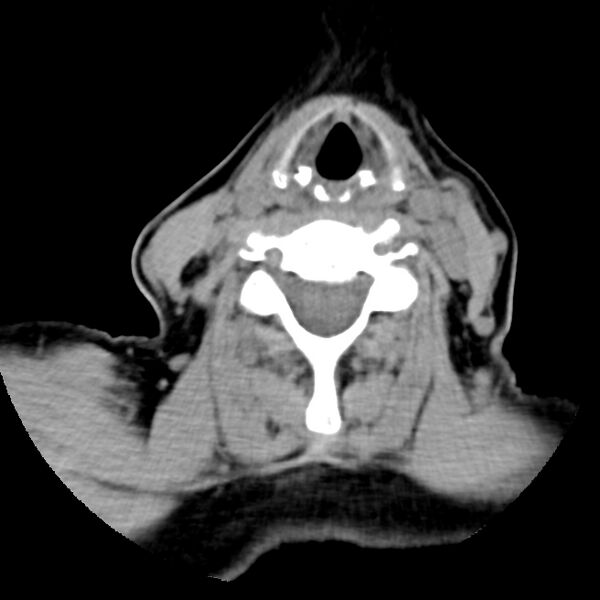 File:Calcified meningioma - cervical canal (Radiopaedia 70136-80171 B 22).jpg