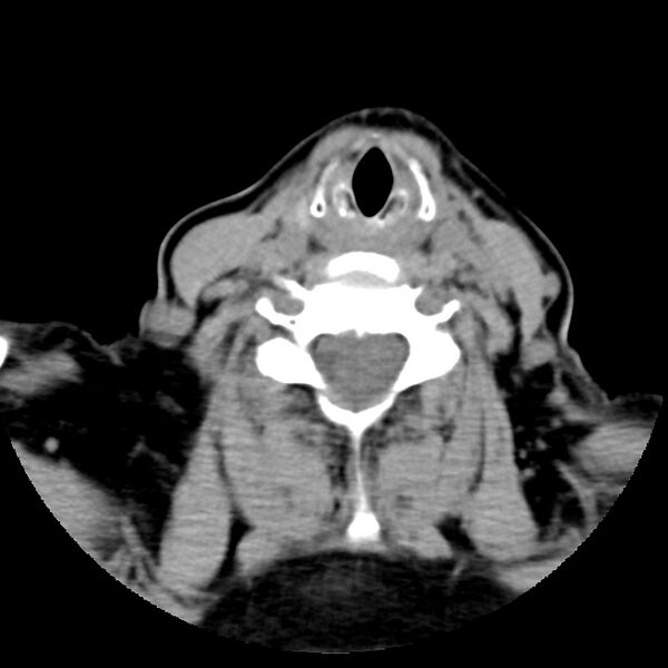 File:Calcified meningioma - cervical canal (Radiopaedia 70136-80171 B 25).jpg