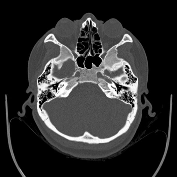 File:Calvarial osteoma (Radiopaedia 36520-38079 Axial bone window 25).jpg