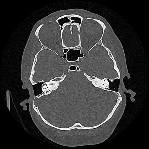 File:Canal up mastoidectomy (Radiopaedia 78108-90638 Axial bone window 89).jpg