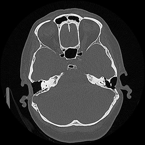 File:Canal up mastoidectomy (Radiopaedia 78108-90638 Axial bone window 93).jpg