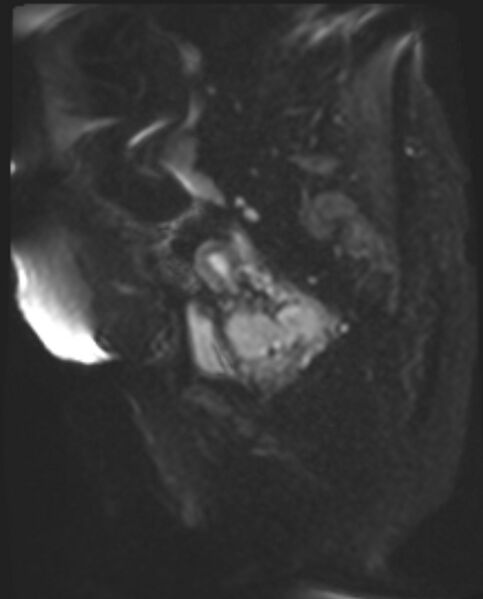 File:Cancer cervix - stage IIb (Radiopaedia 75411-86615 Sagittal DWI 31).jpg