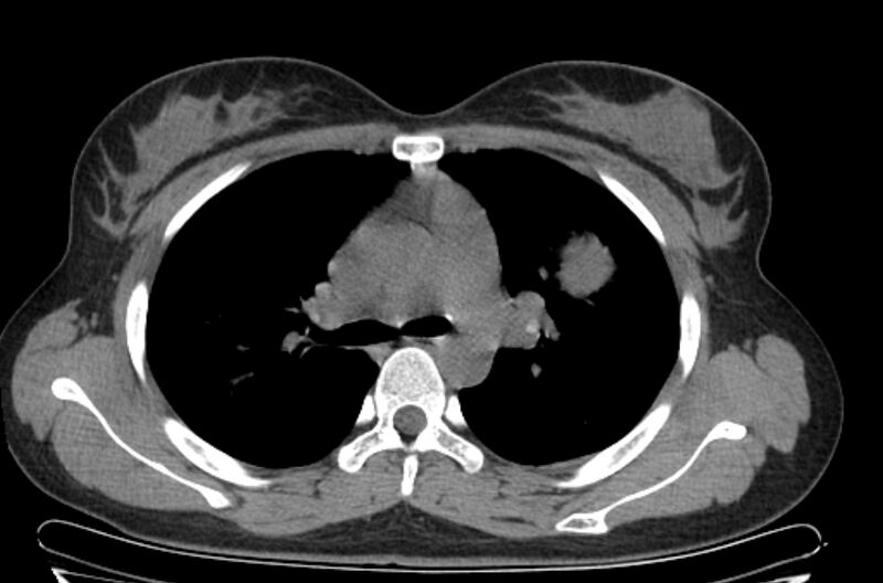 File:Cannonball metastases - uterine choriocarcinoma (Radiopaedia 70137-80173 Axial non-contrast 39).jpg