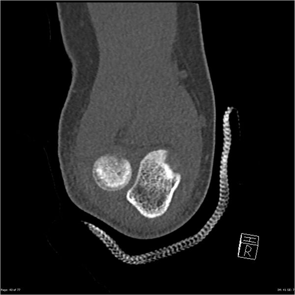 File:Capitellum fracture (Radiopaedia 23352-23426 Coronal bone window 40).jpg