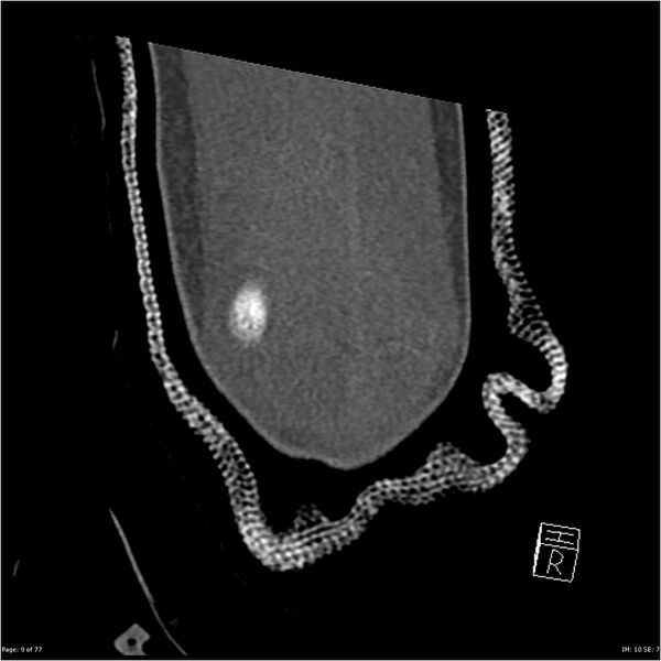 File:Capitellum fracture (Radiopaedia 23352-23426 Coronal bone window 9).jpg