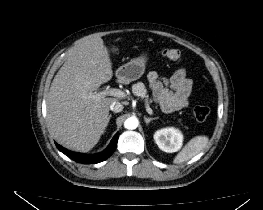 Carcinoid tumor with hepatic metastases (Radiopaedia 22651-22670 B 25).jpg
