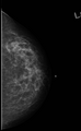 Carcinoma left breast (Radiopaedia 24885-25141 D 1).png