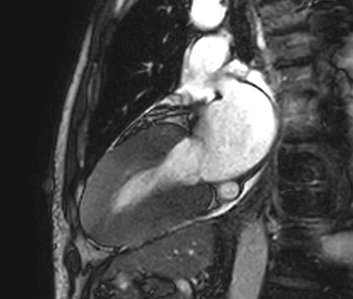 File:Cardiac amyloidosis (Radiopaedia 39736-42124 B 11).jpg