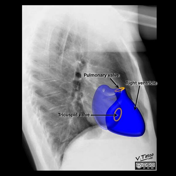 File:Cardiomediastinal anatomy on chest radiography (annotated images) (Radiopaedia 46331-50748 Q 3).jpeg