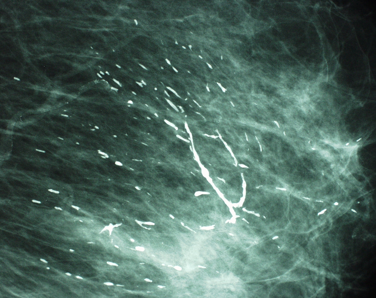 File:Casting calcifications left breast (Radiopaedia 18654).png
