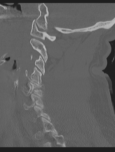 File:Cavernoma of cervical cord (Radiopaedia 50838-56346 Sagittal bone window 29).png