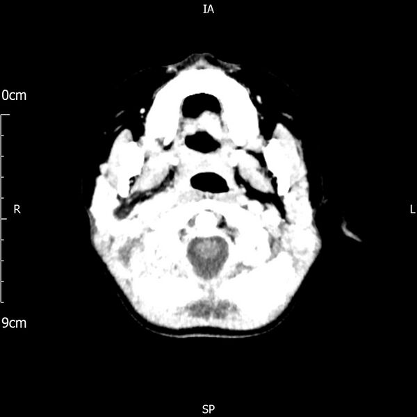 File:Cavernous sinus thrombosis (Radiopaedia 79414-92510 Axial Brain 42).jpg