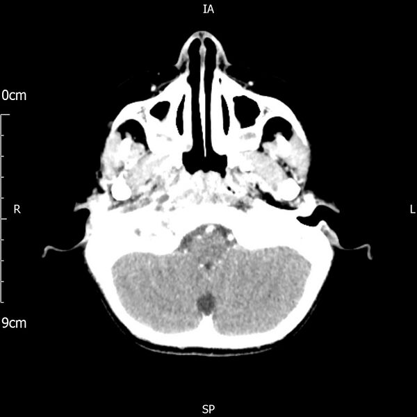 File:Cavernous sinus thrombosis (Radiopaedia 79414-92510 Axial Brain 55).jpg