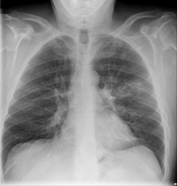 File:Cavitating pneumonia complicated by pneumothorax (Radiopaedia 48149-52992 Frontal 1).png