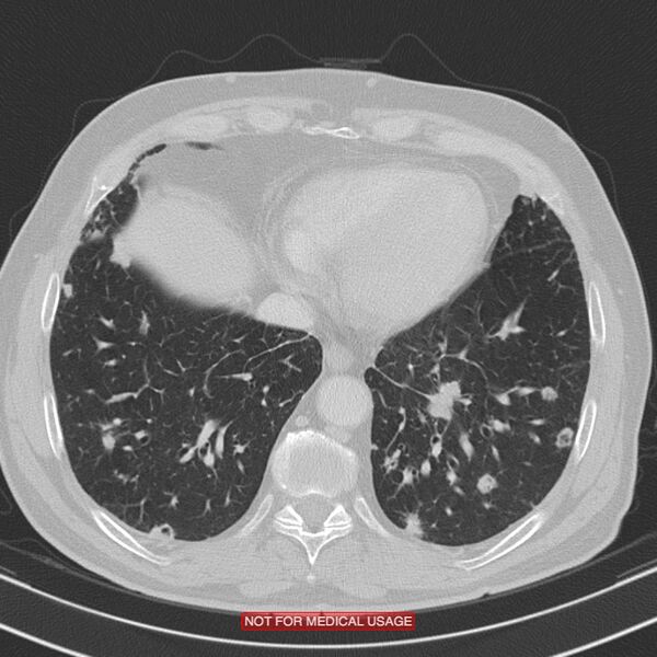 File:Cavitating pulmonary metastases (Radiopaedia 24920-25184 Axial lung window 18).jpg